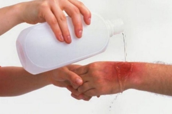 Как помочь при ожоге в домашних условиях? Житель Бреста интересуется Как помочь при ожоге в домашних условиях? Житель Бреста интересуется