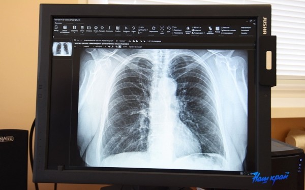 Сколько больных туберкулезом выявляется за год в Барановичском регионе Сколько больных туберкулезом выявляется за год в Барановичском регионе