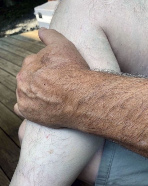 Эти фотографии показали, почему использовать солнцезащитный крем — хорошая идея! Эти фотографии показали, почему использовать солнцезащитный крем — хорошая идея!