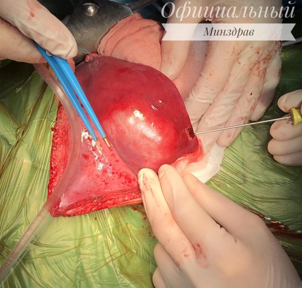 Спасли двухмесячного малыша. Белорусские хирурги впервые выполнили сложнейшую операцию