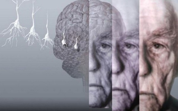 Ученые выявили, что болезнью Альцгеймера можно заразиться Ученые выявили, что болезнью Альцгеймера можно заразиться